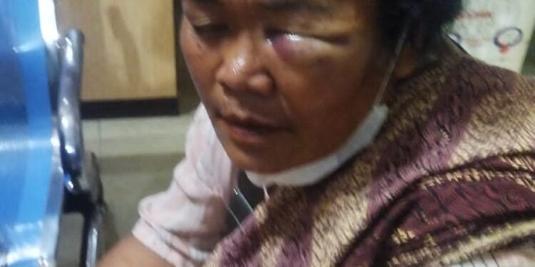 Keterangan Foto: Tiomeril Sitinjak, Korban pemukulan konflik PTPN III Kebun Bangun